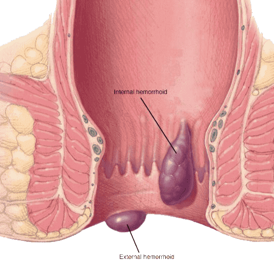मानव शरीर में बवासीर कैसे होती है - Piles Treatment Anatomy Diagram