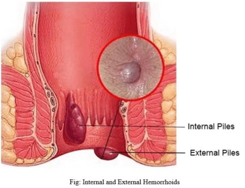 प्रोलैप्सड बवासीर (Prolapsed Hemorrhoids)